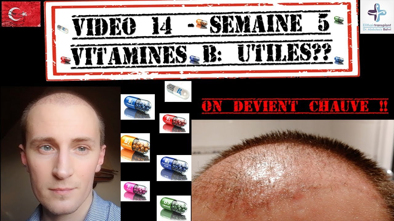 Vitamines B, Utiles?? Après "Ma Greffe FUE De Cheveux à Istanbul [14 ...