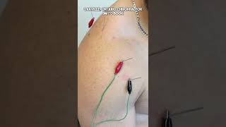 Watch his muscles twitch! #accupuncture #chiropracticadjustment