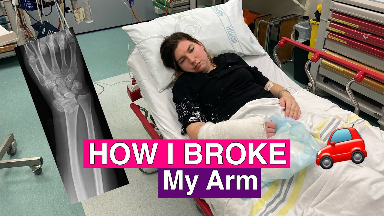 How I Broke My Arm In 2021 - YouTube