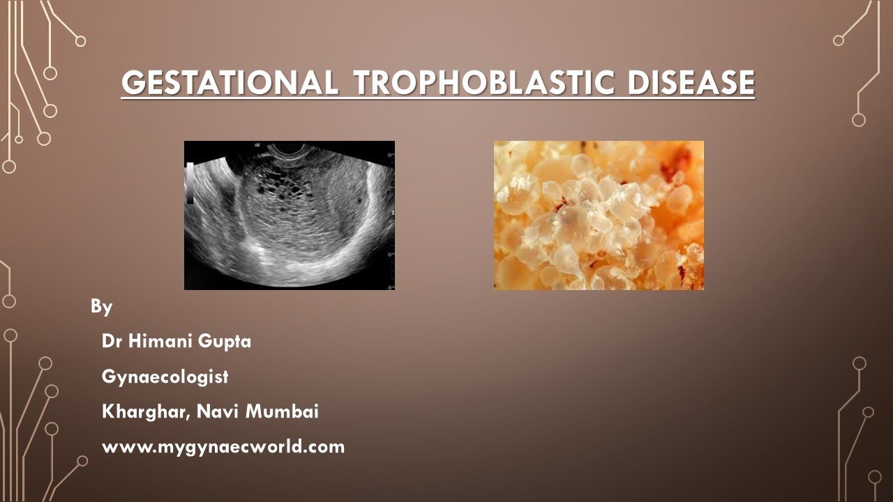 Gestational Trophoblastic Disease ( Video Series-Epi-1) - YouTube