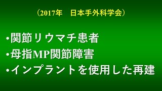 リウマチ母指MP関節障害に対するインプラントを使用した再建（2017年報告）＃母指ボタン穴変形　#関節形成術　＃シリコンインプラント