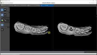 Implantodontia - escaneamento com CS 3600 da CArestream da posição do implante com e sem scanbody