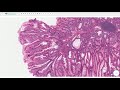 peutz jeghers polyp histopathology