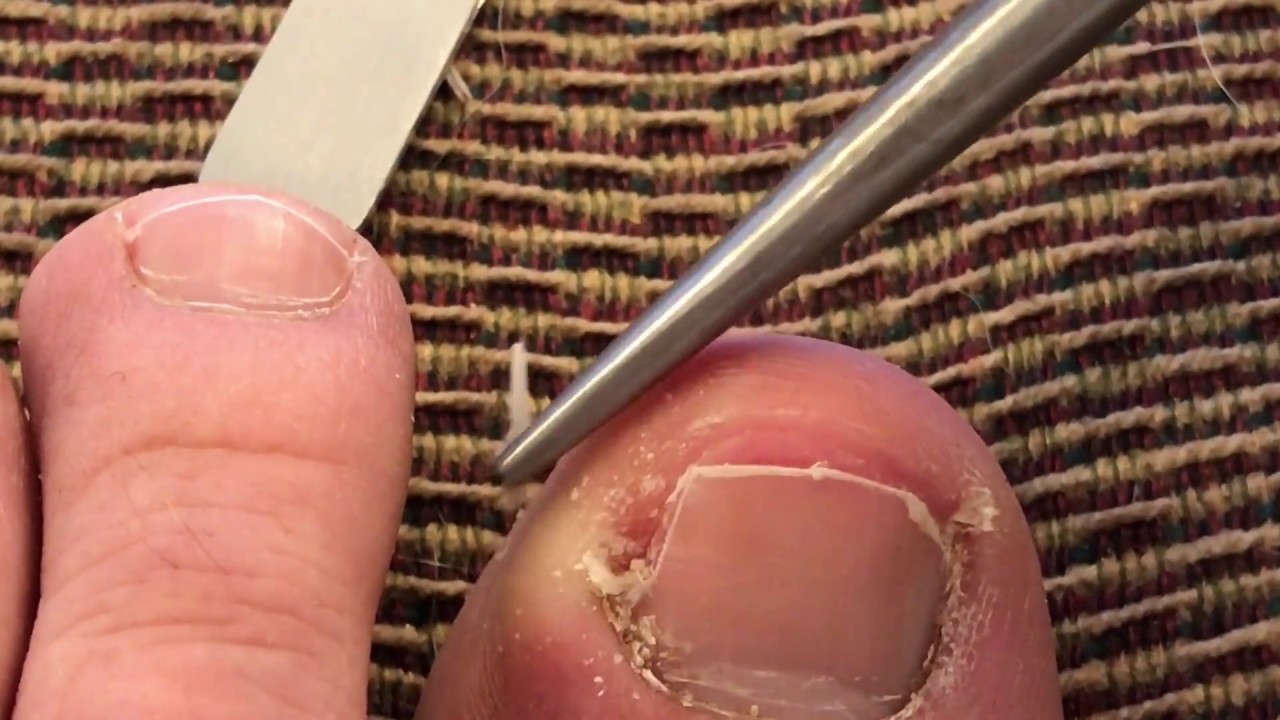 Ingrown Toenail Removal - YouTube