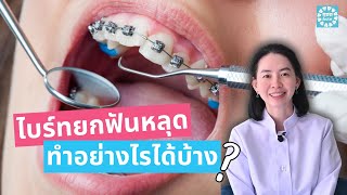 Turbobite ไบท์ยกฟันหลุด สำหรับคนจัดฟันต้องดู