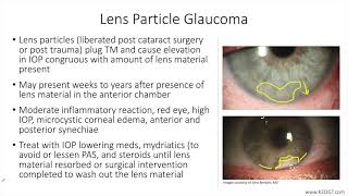 Lecture: Lens Particle Glaucoma (1 Slide in 5 Minutes)