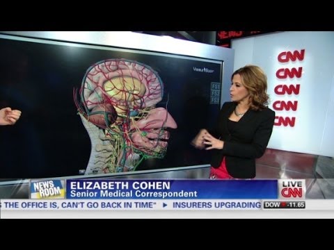Explaining what a mini-stroke means Explaining what a mini-stroke means