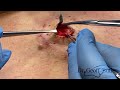 removal of epidermal cyst on back