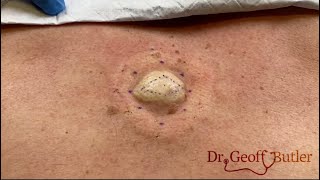 Removal of Epidermal Cyst on Back