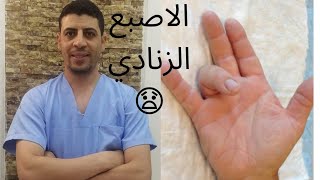 الاصبع الزنادي |الاصبع الزنادية|الاصبع الزنادية وعلاجها|تمارين اصبع الزناد|دكتور احمد حسن جمعه