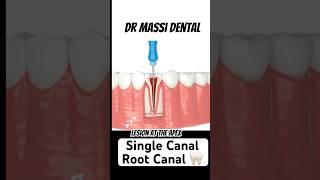 Single Canal Root Canal video