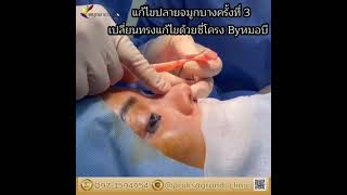 รีวิวแก้ไขปลายจมูกบางครั้งที่ 3 ด้วยซี่โครง Byหมอบี