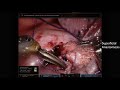 Robotic Sleeve Resection of a Bronchus Intermedius Tumor