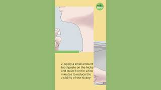 How To Remove A Hickey In Seconds With Toothpaste