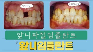 앞니 치아 파절/부러짐 뿌리만 남은 앞니 발치 및 임플란트 치료