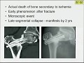 Neck of femur fractures