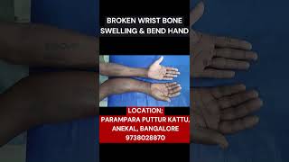 WRIST DANGER FRACTURE | BANGALORE PUTTUR KATTU | RADIUS FRACTURE | ANEKAL PUTTUR KATTU