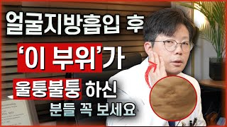 얼굴지방흡입 후 생기는 '이것' 단순한 '바이오본드' 라고 생각하시면 안됩니다