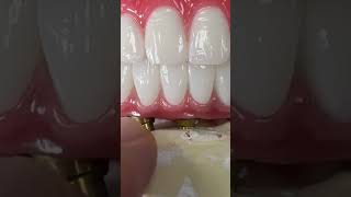 Denture vs mono zirconia with only 3 implants