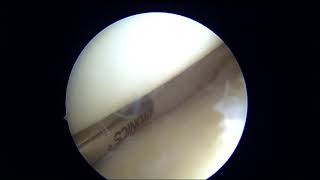 Arthroscopic Meniscectomy