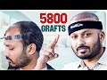 Hair Restoration Surgery: 5800 Grafts Hair Transplant 😃 | Bangladesh | New Roots