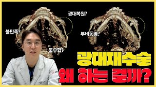 광대 재수술을 가장 많이 하는 원인? 불유합, 부비동염, 광대복원, 재수술