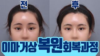 이마거상복원 회복과 부작용 테일러성형외과