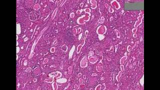 Histopathology Kidney--Chronic glomerulonephritis