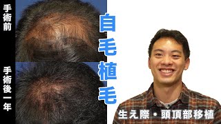 [One year after hair transplantation] We interviewed a person who had 2500 hairline transplants.