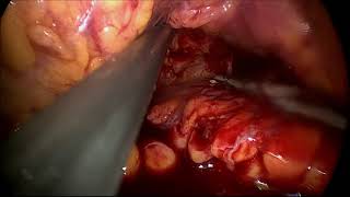 Emergency Laparoscopic drainage of multiple collections after severe acute pancreatitis