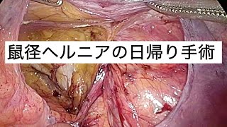 鼠径ヘルニアの日帰り手術 - 腹腔鏡による手術動画