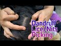 Lice Nits Picking on Long Black Silky Hairs Head Scalp View | ASMR Pakistan