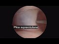 Suprapatellar Plica and loose body