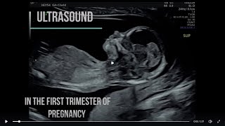 Diagnostic Ultrasound in the First Trimester -  scanning basics \u0026 new screening modalities