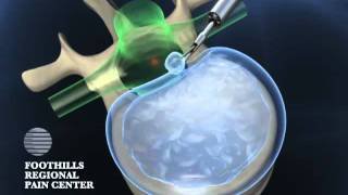 Full-endoscopic microdiscectomy for herniated disc, transforaminal approach