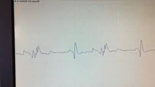 Complex repetitive discharge