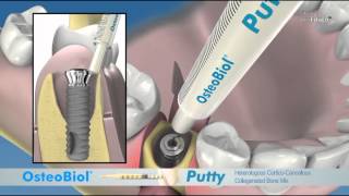 OsteoBiol® Putty