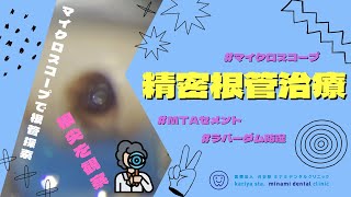 精密根管治療　【愛知県刈谷市の歯医者】　抜歯をしたくない　根管治療のやり直し　MTAセメント　マイクロスコープ　バイオセラミックス　自由診療　顕微鏡歯科　Micro Endodontics