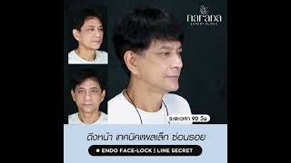 ผ่าตัดดึงหน้า Endo Face Lock แผลเล็กซ่อนรอย ที่ นารดาคลินิก