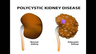 Chronic kidney disease. By Dr. Dheyaa Jabbar