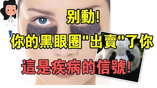 你一定不知道！黑眼圈，是5種疾病的信號！引起黑眼圈的原因不只是睡眠不足！