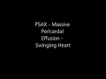 Massive Pericardial Effusion - Swinging Heart - Transthoracic Echocardiogram (TTE)