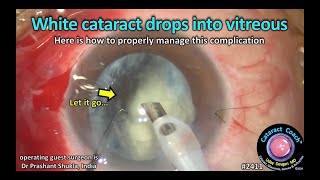 CataractCoach™ 2411: white cataract drops intro vitreous