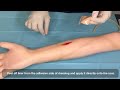 wound free silicone scar dressing by ad surgical