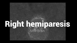 Right hemiparesis #TheReportingRoom