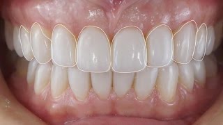 Лечение стираемости зубов. Реставрация зубов по силиконовому ключу. Front teeth restoration.