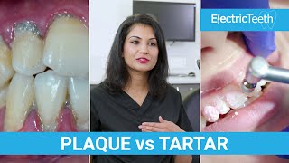 Plaque vs Tartar - How To Remove