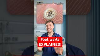 Foot warts explained for your medical exams!