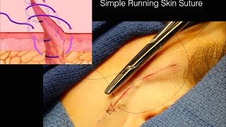 Live Surgery: What is Simple Running Suture Skin Closure? How to perform Simple Running Stitch.