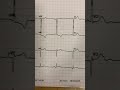 INFARTO EN PACIENTE FEMENINO DE 43 AÑOS CON DIABETES HIPERTENSIÓN ARTERIAL Y ATEROSCLEROSIS